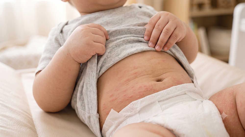 Best Tools for Baby Nappy Rash Rapid Relief